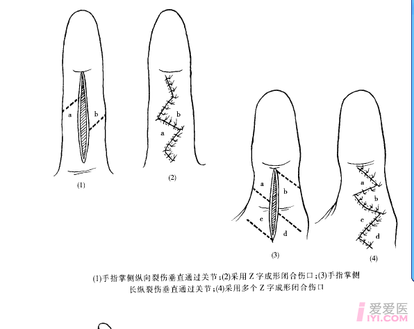 我想请问一下手指的z字成型怎么做切口怎么设计